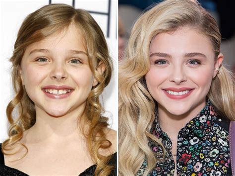 What Happened To Chloë Grace Moretz Teeth 